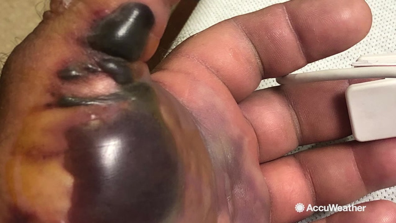 Florida man shares his road to recovery after nearly dying from flesh-eating bacteria