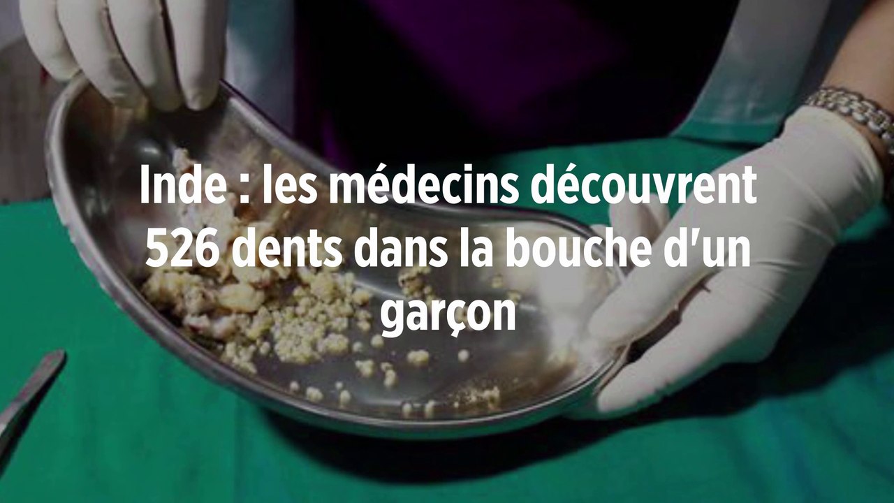 Inde : les médecins découvrent 526 dents dans la bouche d'un garçon