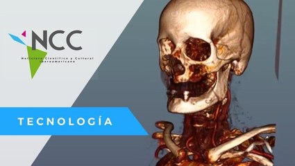 Desarrollan software que facilita la detección de lesiones cerebrales
