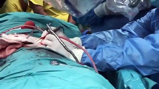 Separan a siamesas unidas por la cabeza en Bangladés