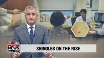 Number of shingles patients on rise, especially among 30s and 40s