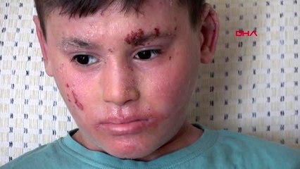 İZMİR Balık derisi hastası Kayra'ya kolilerce krem yardımı