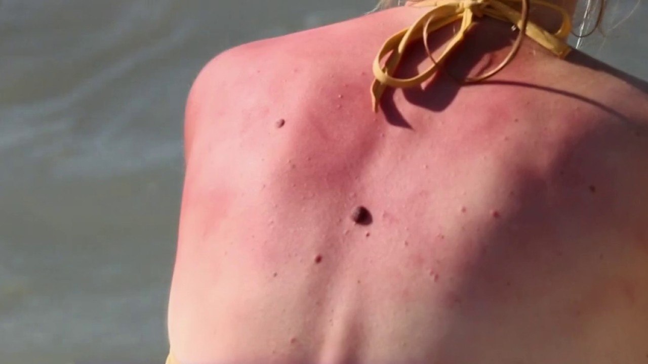 Santé - Brûlures : les gestes d’urgence