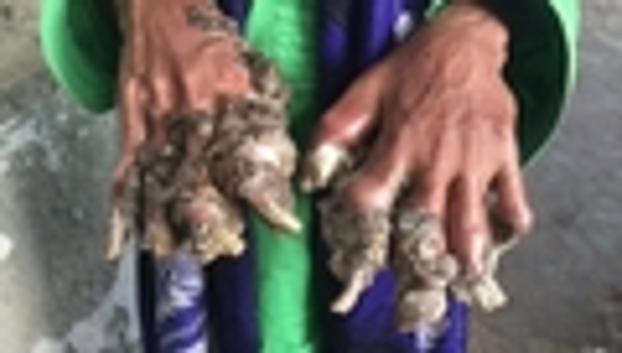 El 'hombre árbol' de Bangladesh regresa al hosp...