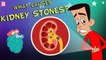 What Causes Kidney Stones? | The Dr. Binocs Show | Best Learning Videos For Kids | Peekaboo Kidz