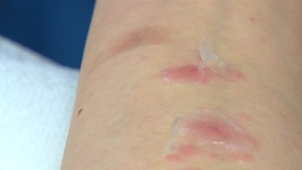 여름철 대상포진 환자 증가...면역력 높여야 / YTN