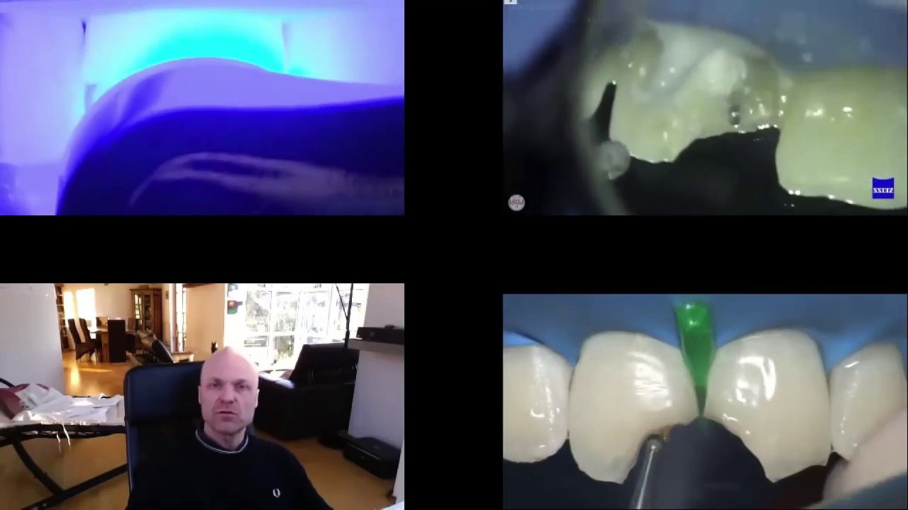 Zahnaufbau mit Kunststoffeck oder Veneer