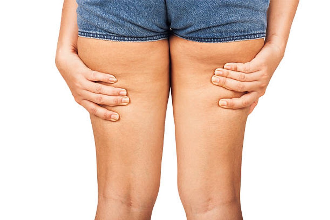 Comment éviter l'irritation des cuisses pendant l'été ?