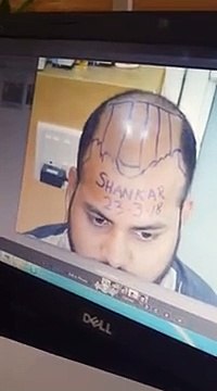 Hair Transplant in Pune | Patient Review | Dr Amitabh Shrivastava, Sai Cosmetics