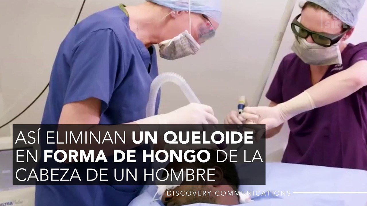 Así eliminan un queloide en forma de hongo de la cabeza de un hombre