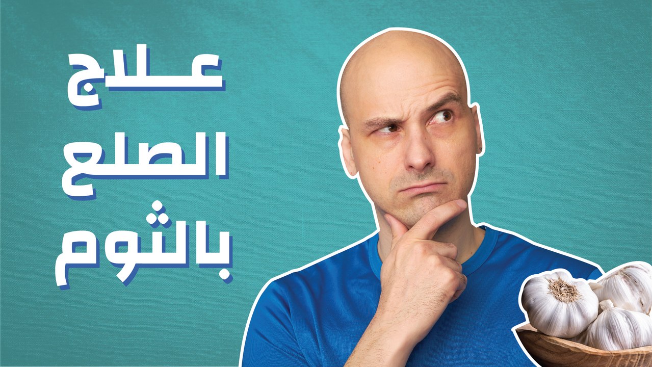 علاج الصلع بالثوم