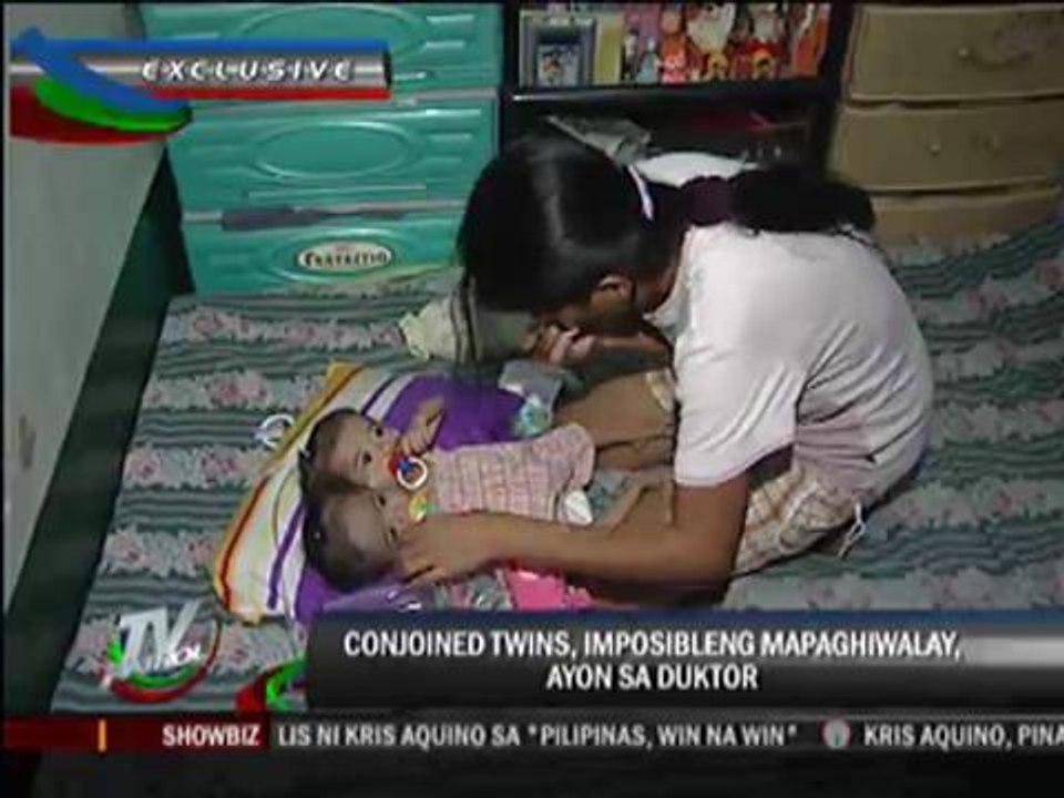 Conjoined twins can’t be separated, says doc