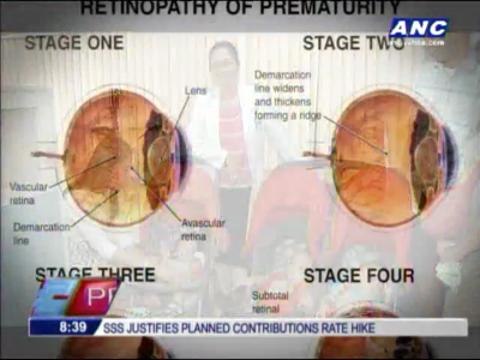 Premature babies at risk of blindness- study