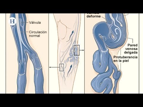 Riesgos y peligros que provocan las varices