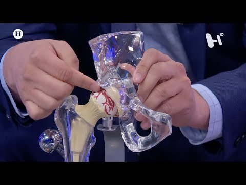 Cirugía de cadera, ¿cuándo es necesaria?