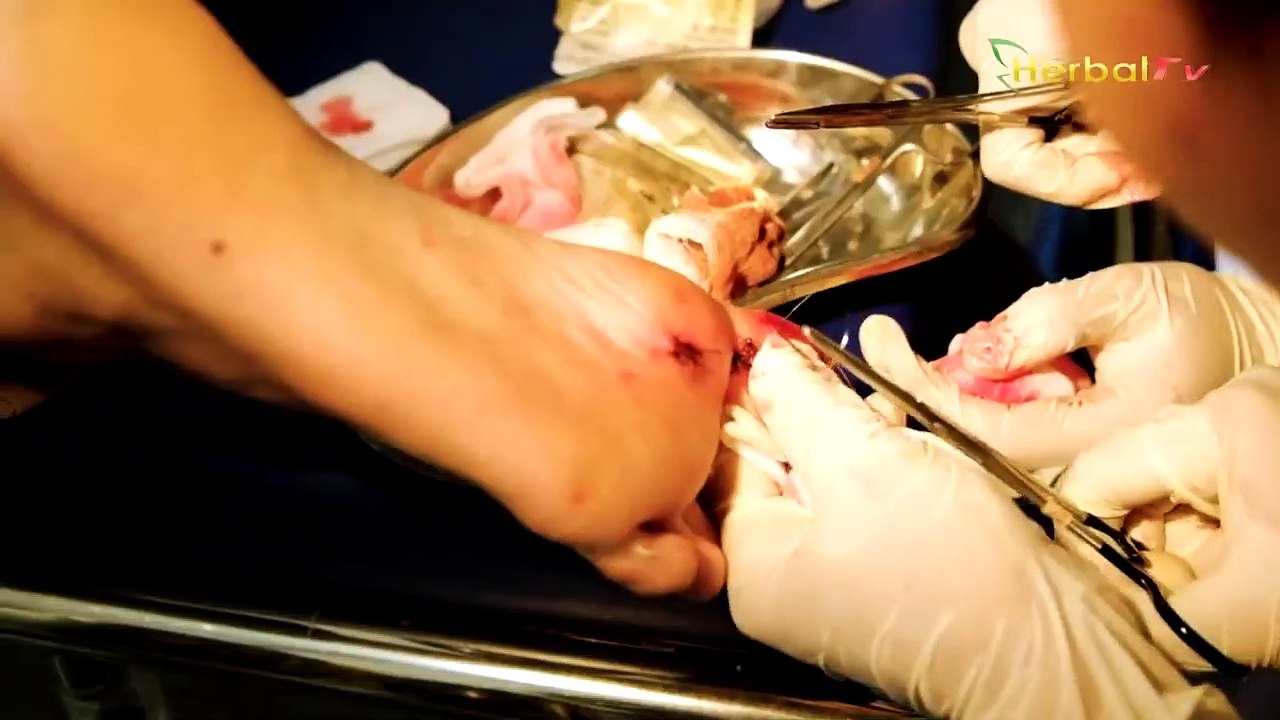 Batuk Sembuh, Dahak Serta Lendir Paru paru Hilang Dengan Bahan Alami Berikut