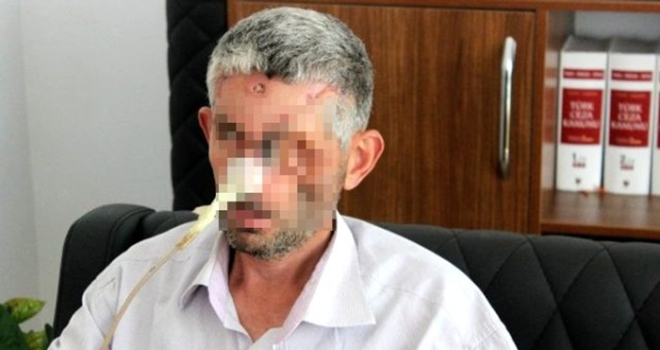 Dişini çektirmek için hastaneye giden adam, gözünden oldu!