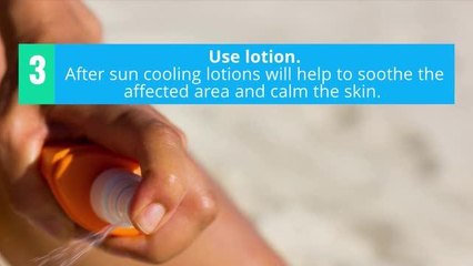 How to treat sunburn