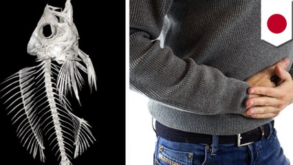 Man gets surgery to remove fish bone stuck in his small intestine