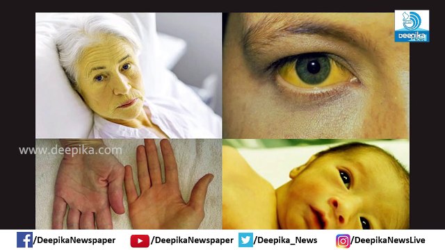 മഞ്ഞപ്പിത്തം: ശ്രദ്ധിക്കണം ഈ കാര്യങ്ങള്‍, അറിയേണ്ടതെല്ലാം Jaundice; Health Tips, Things to Care