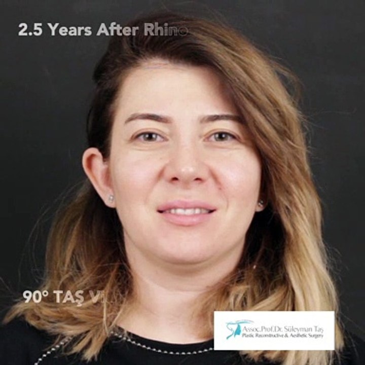 Closed Atraumatic Rhinoplasty