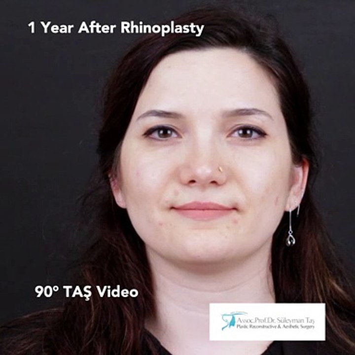 Closed Atraumatic Rhinoplasty