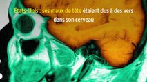 États-Unis : ses maux de tête étaient dus à des vers dans son cerveau