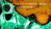États-Unis : ses maux de tête étaient dus à des vers dans son cerveau