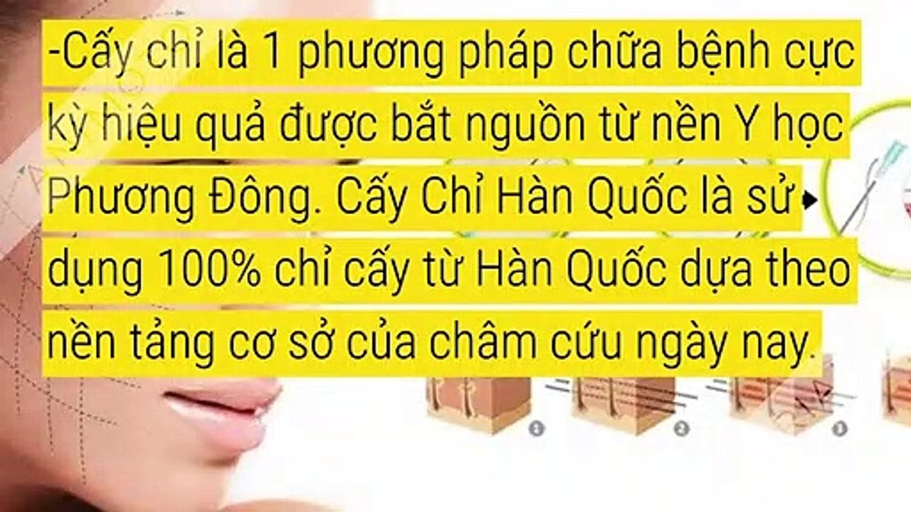 Cấy chỉ Hàn Quốc