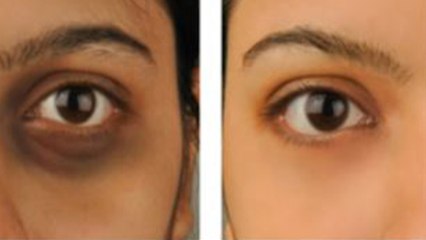 आंखों के काले घेरे | Best food to get rid of Dark Circles | Dark Circle Natural Treatment | Boldsky