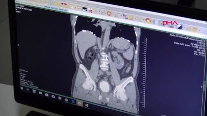 ELAZIĞ Mesanesinde 220 gramlık tek parça taş çıktı