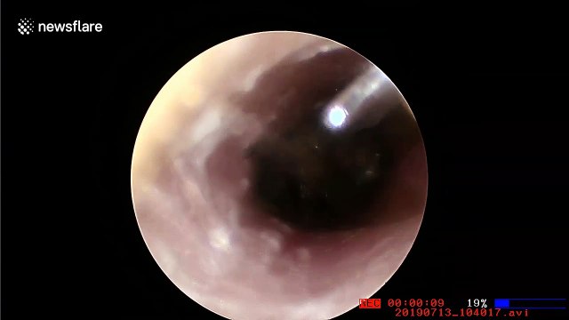 Doctor in Vietnam removes bee that was burrowing in man's ear
