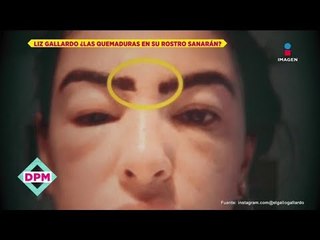 Así está Liz Gallardo tras quemaduras por procedimiento de belleza | De Primera Mano
