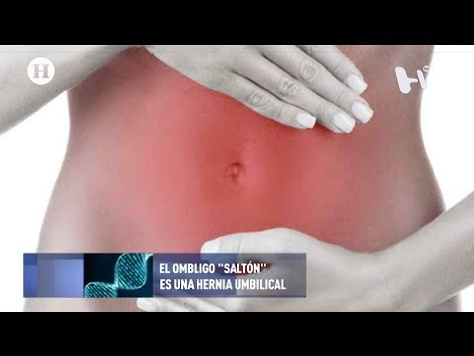 ¿Qué es y cómo se trata una hernia umbilical?