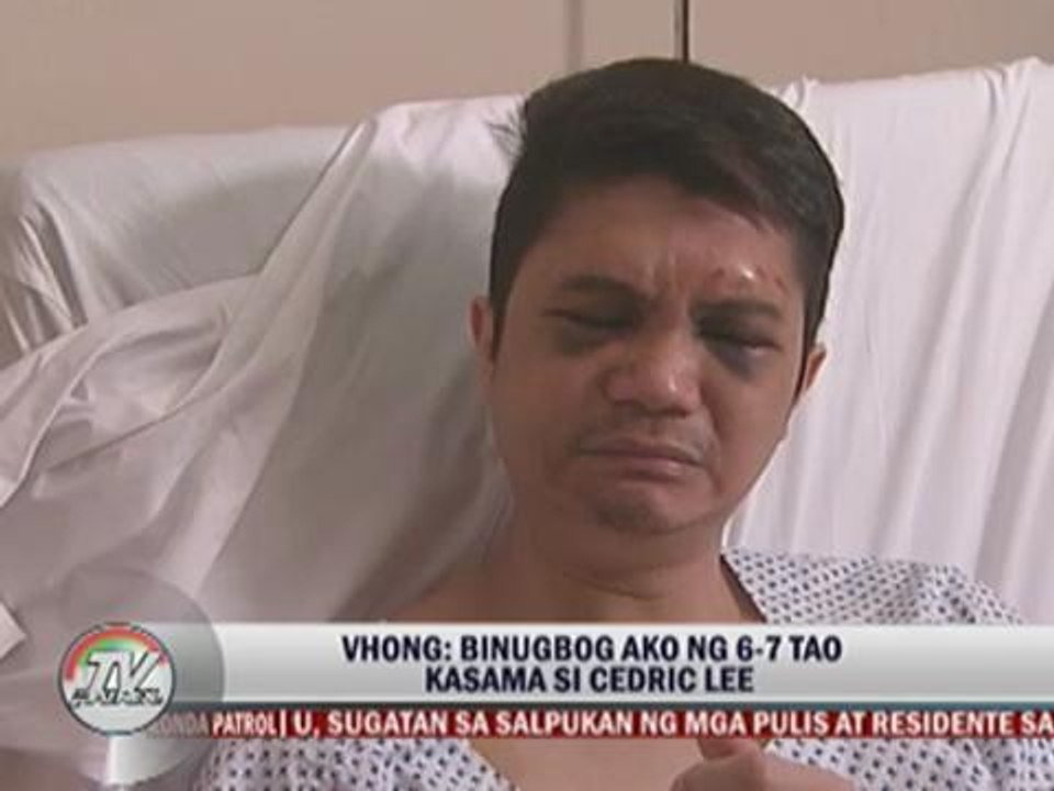 Vhong to undergo reconstructive nose surgery