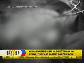 First Pinoy to undergo intestine transplant 'doing well'