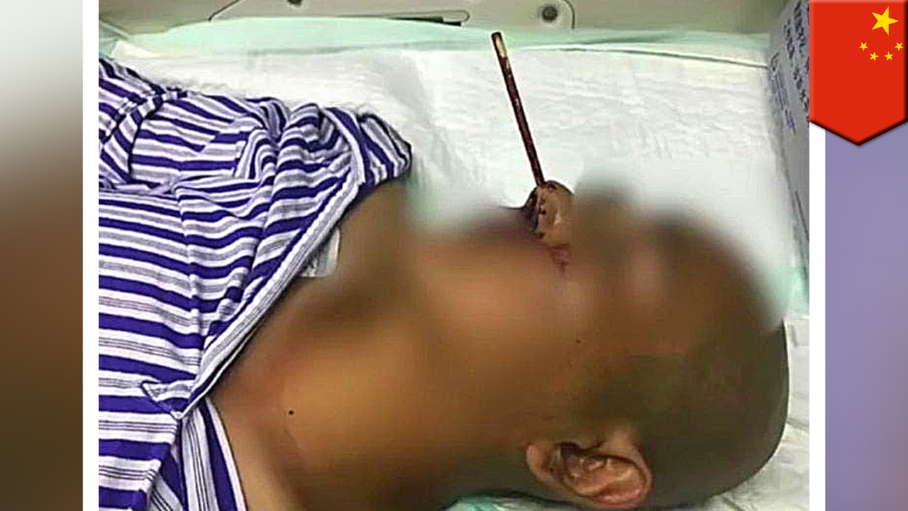 Man picks his nose withchopstick and nearly dies