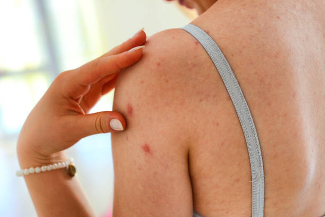 How to treat Shingles?