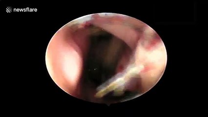 Live leech pulled from the nose of six-year-old boy in Vietnam