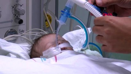 Ankara 12 günlük bebeğe yapay damar