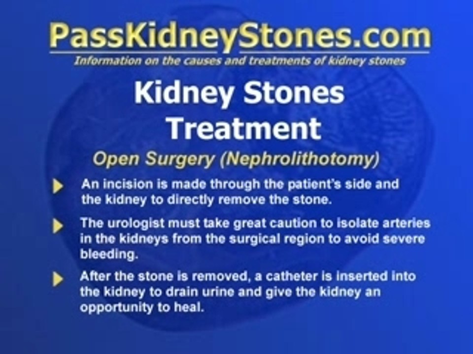 Open Surgery For Kidney Stones video Dailymotion