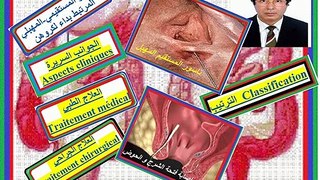 Crohn et fistule recto-vaginale