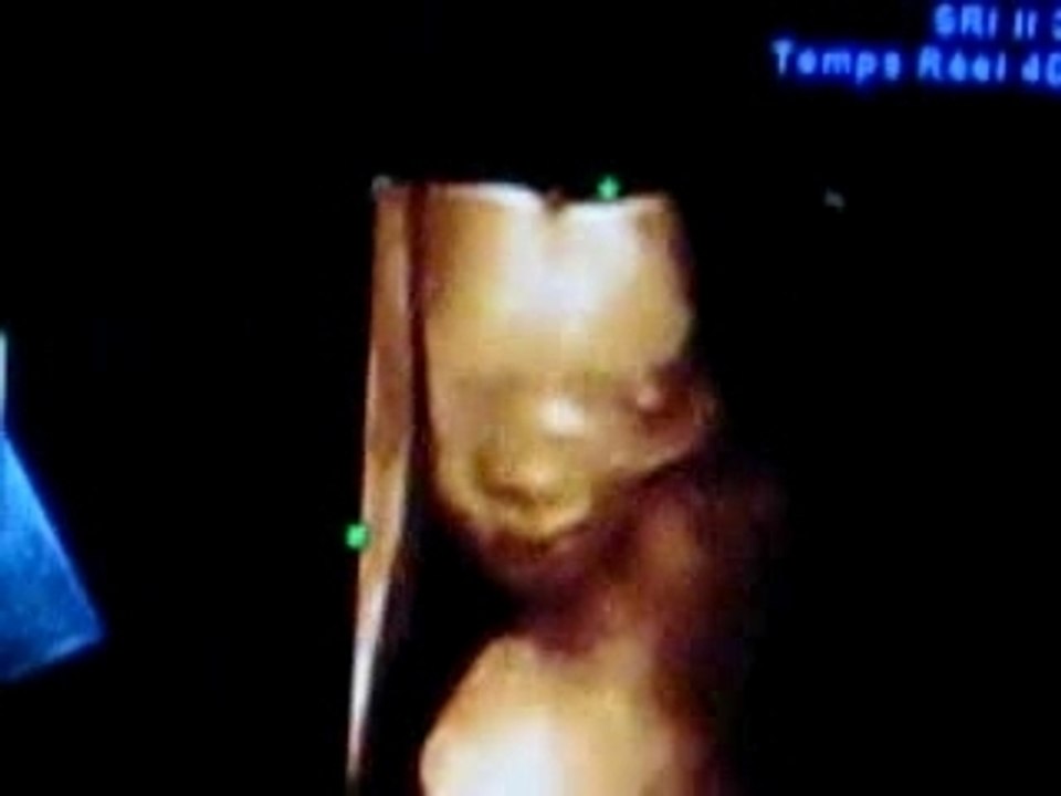 echographie Lyana