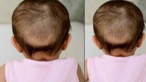 बच्चों के बालों के झड़ने के पीछे ये है वजह | Hair Loss in Babies | Boldsky