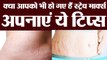 स्ट्रेच मार्क्स दूर करने के ये है घरेलू उपाय | Home remedy for Stretch Marks | Boldsky