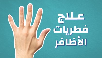 علاج فطريات الأظافر