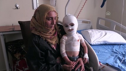 Üzerine kaynar su dökülen minik Yunus Emre iyileşeceği günü bekliyor - ERZURUM