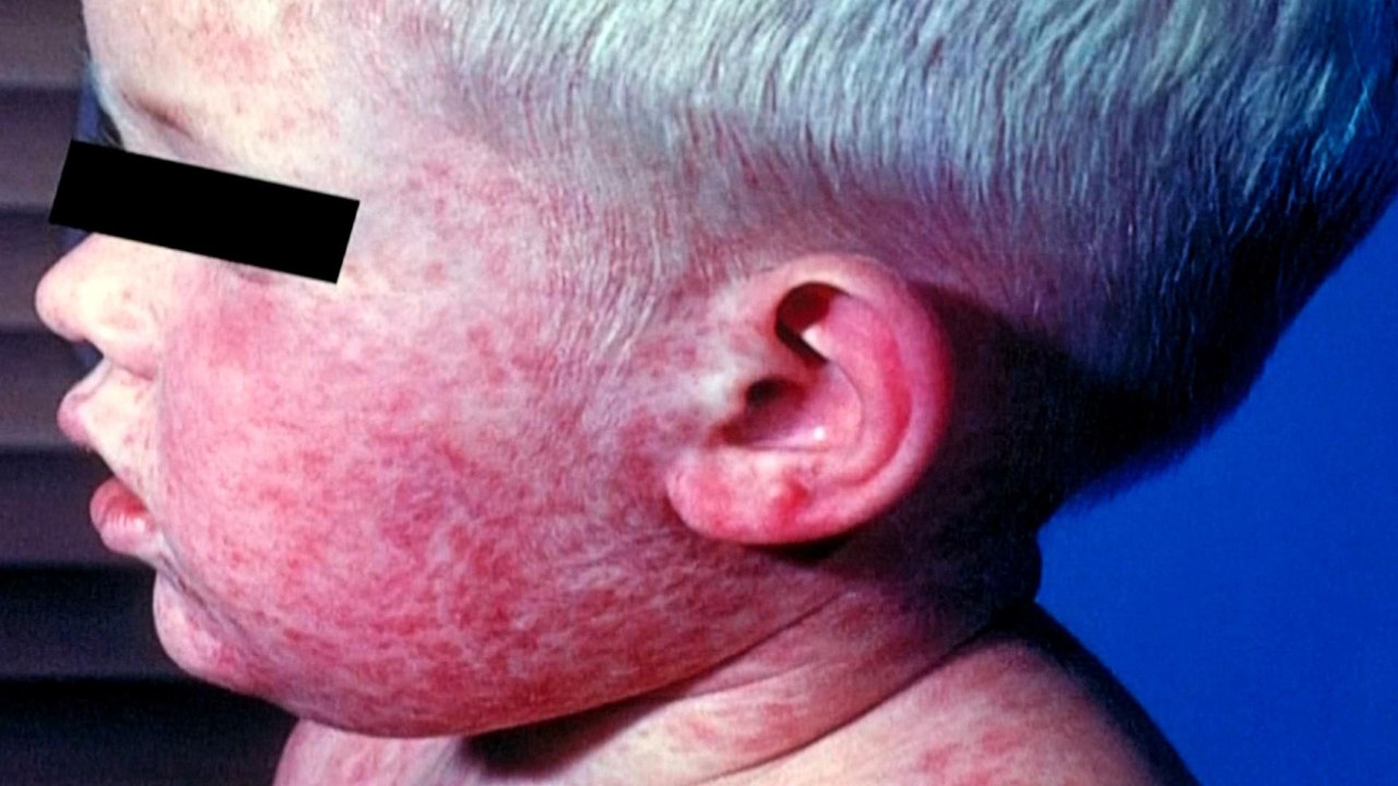 Vaccination challenges: Compulsory immunisation in Malaysia