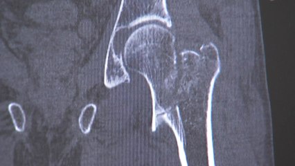 중년 여성 위협하는 골다공증...방치하면 골절 위험 증가 / YTN