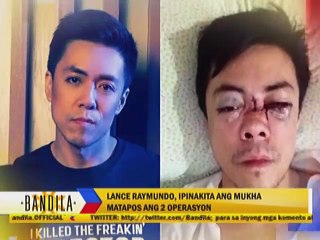 Bagong mukha ni Lance Raymundo, ipinakita na